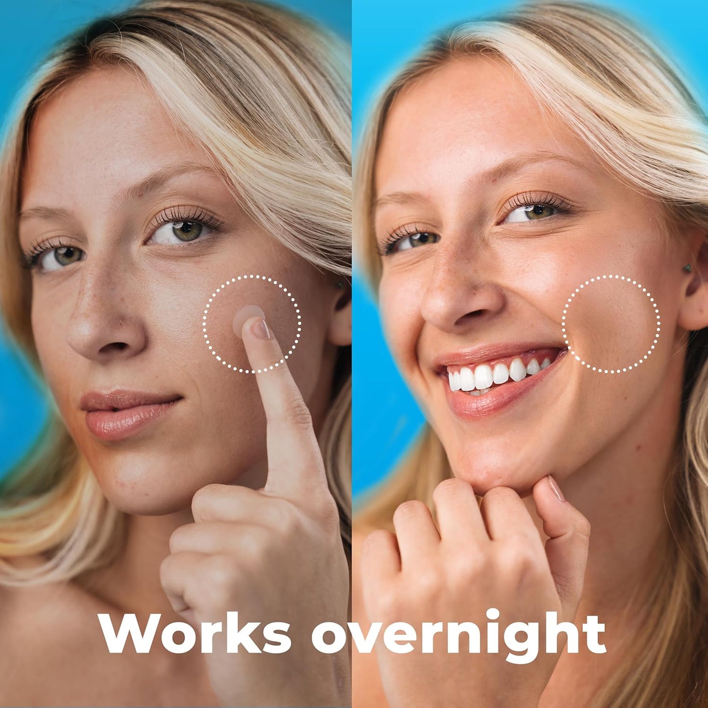 Pimple Patches for Face (120 Patches), Hydrocolloid Acne Patches with Tea Tree Oil, Pimple Patch Pimple Stickers - Hydrocolloid Patch Acne Dots - Acne Pimple Patches For Face - Zit Patches