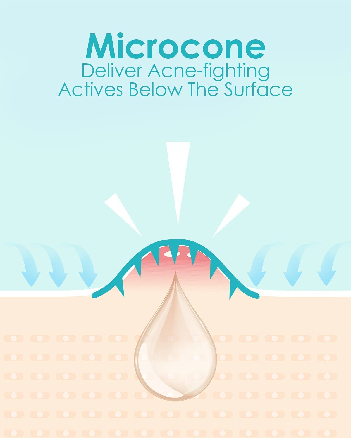 Microdart Acne Patch (27 Patches) - Hyaluronate Acid & Salicylic Acid Hydrocolloid Pimple Patch for Deep, Early and Hidden Blemishes (27 Count (Pack of 1))