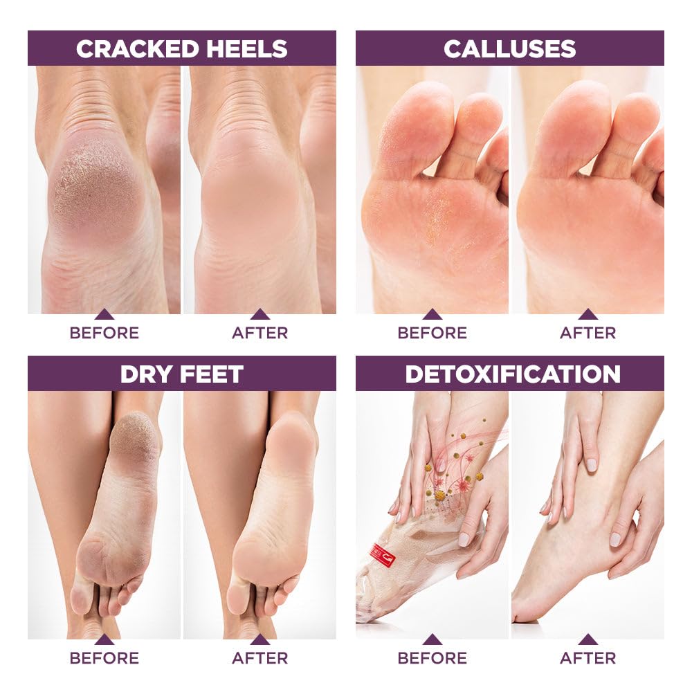 Lavinso Lavender Foot Exfoliator Peeling Mask for Dry Cracked Feet - 4 Pack - Remove Dead Skin and Callus - Foot Peel Mask for Baby Soft Feet