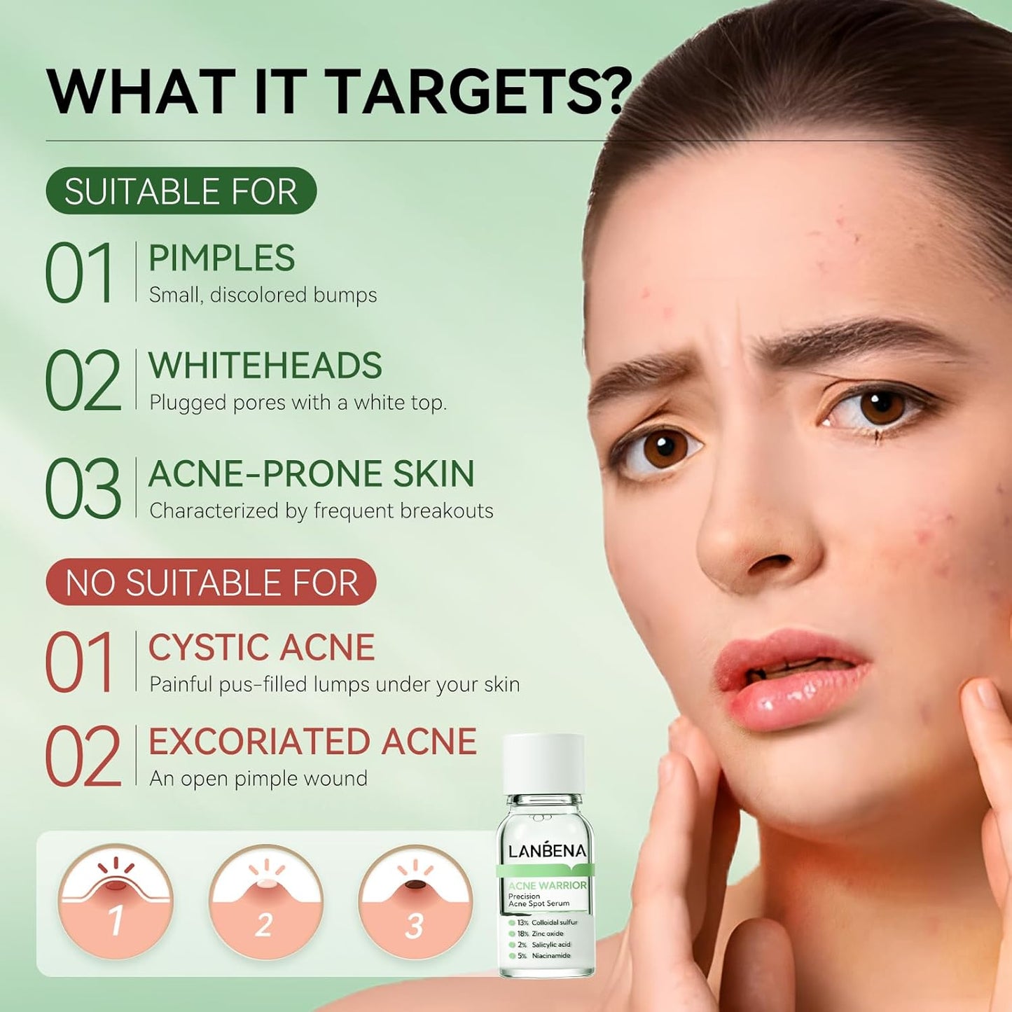 LANBENA Precision Acne Spot Serum, Acne Drying Lotion, Overnight Acne Treatment For Face, Dry Out Pimples, Blemishes, Zits And Clean Pores, 0.42 Fl Oz