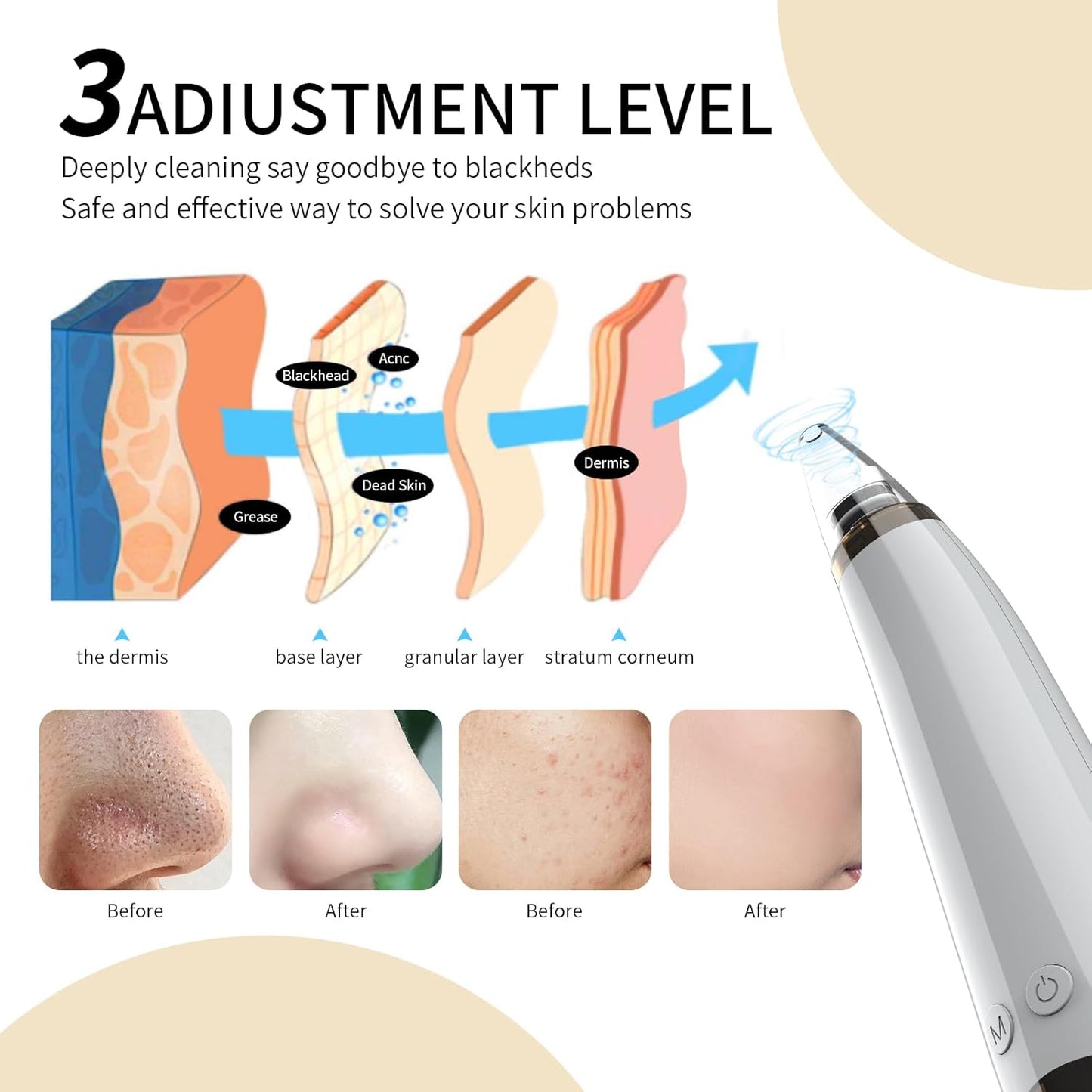 2025 Blackhead Remover Pore Vacuum,5 Suction Power,5 Probes,USB Rechargeable Blackhead Vacuum Kit-Facial Pore Cleaner Electric Acne Extractor Tool