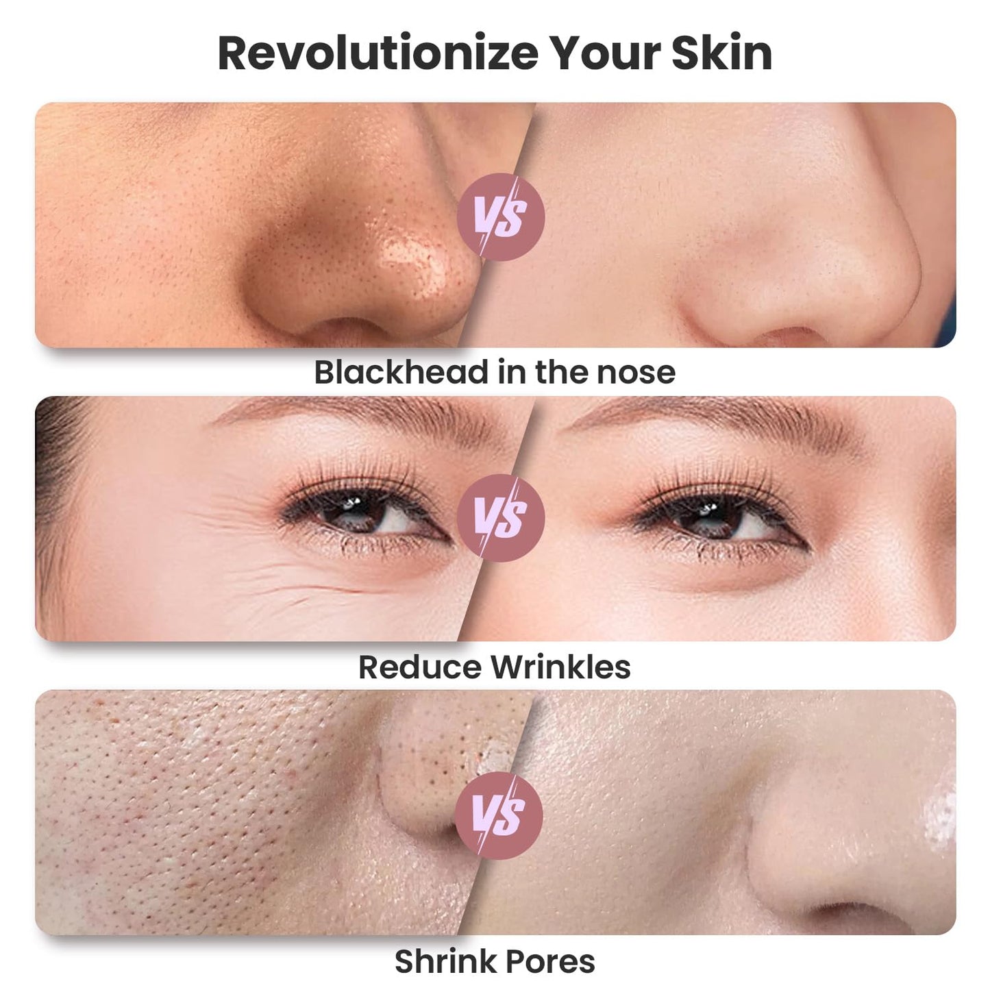 Diamond Microdermabrasion Machine, Portable Blackhead Remover Pore Vacuum, Dermabrasion Facial Machine for Exfoliation & Blackhead Removal