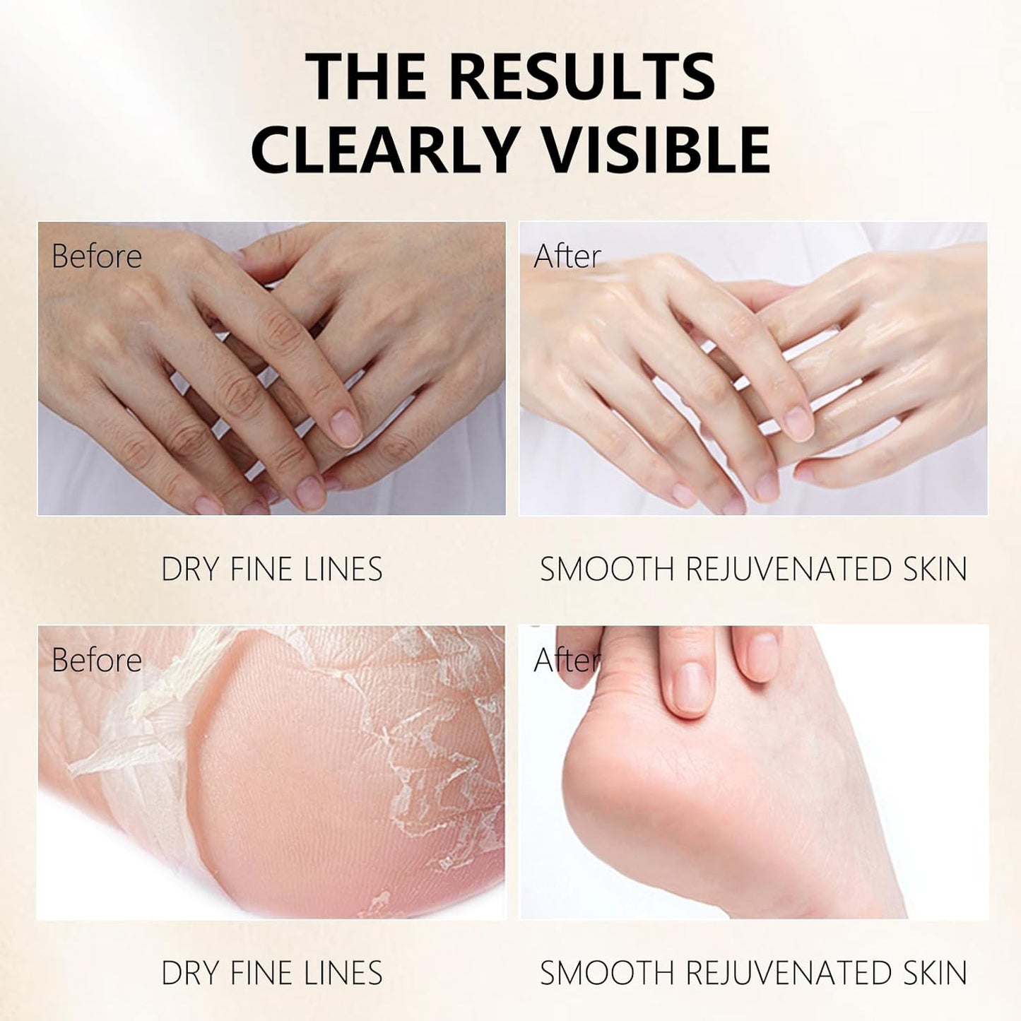 Hydrating Hand Foot Masks Set for Women Men,5 Pack Glove Mask for Dry Hand & 5 Pack Socks Mask for Dry Cracked Feet（Milk）