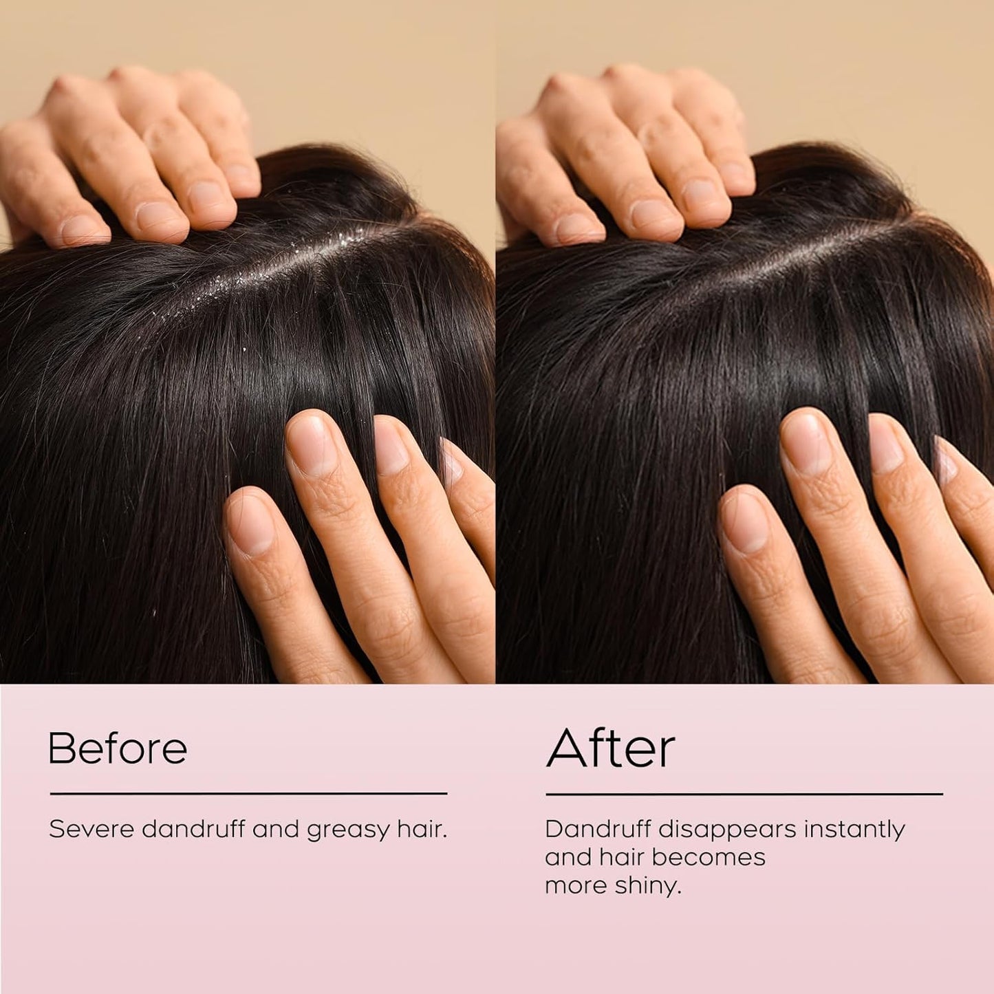 24HR Fast Itch Relief Anti-Fungal Shampoo for Psoriasis, Seborrheic Dermatitis & Folliculitis, Relieves Itchy, Dry Scalp, Sulfate & Paraben Free Anti-Dandruff Shampoo for Men and Women, 8.4 fl oz