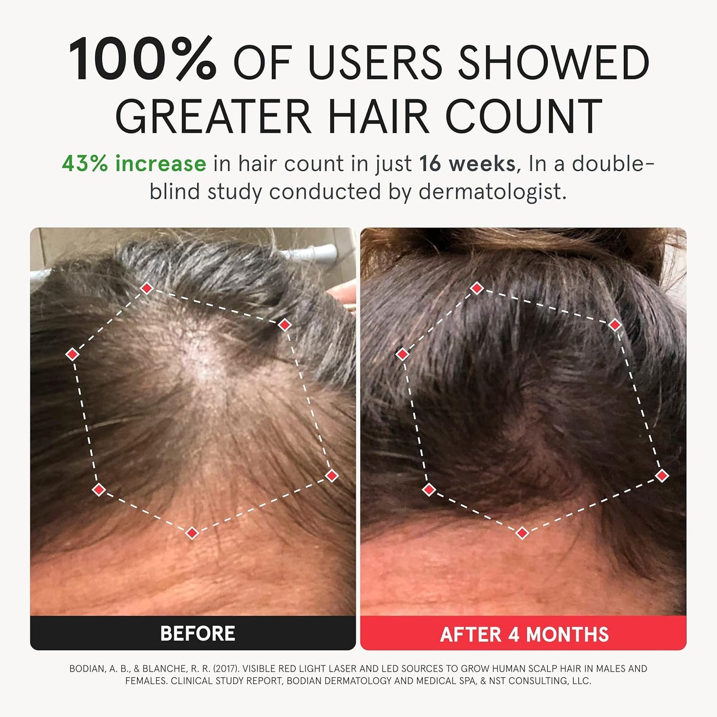 iRestore Elite - Laser Red Light Therapy for Hair Growth System - FDA Cleared Hair Loss, Hair Thinning & Alopecia Treatment for Men & Women - Laser Cap for Hair Regrowth Stimulates Denser Fuller Hair