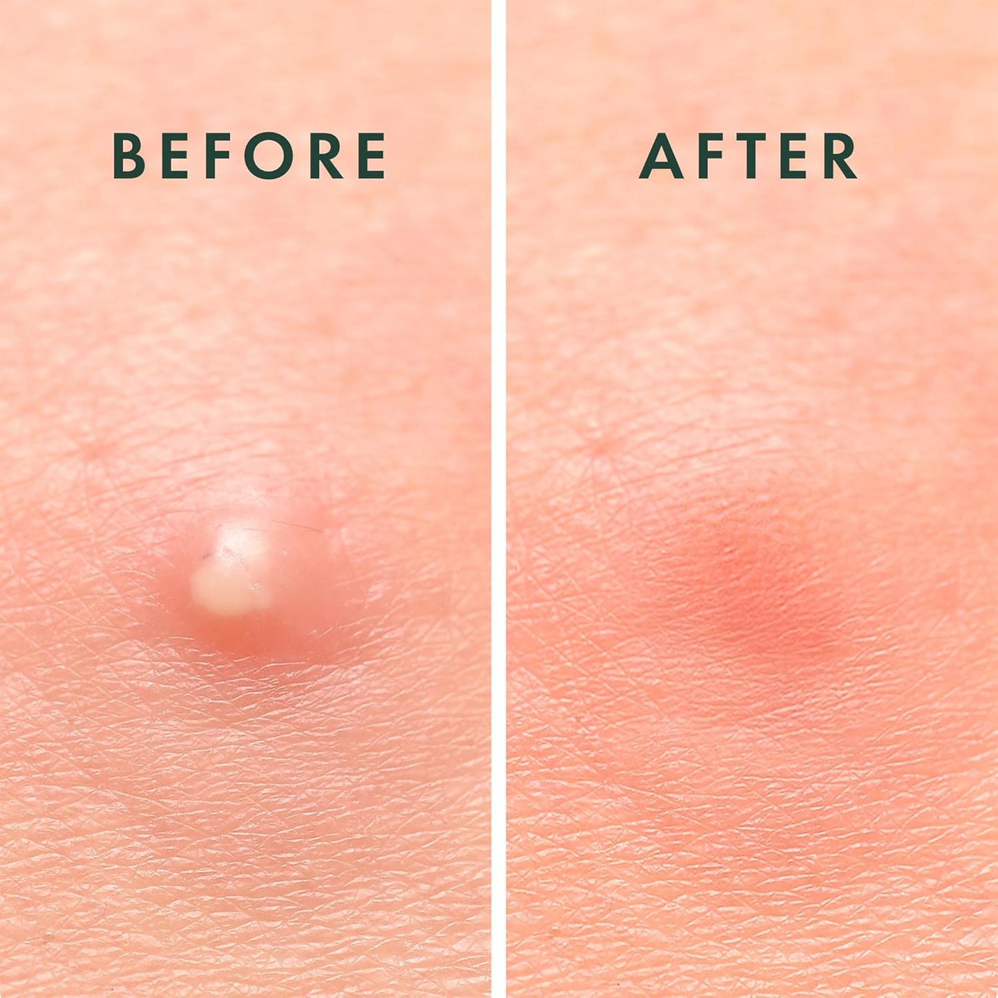 Rael Pimple Patches, Miracle Invisible Spot Cover - Hydrocolloid Acne Patch, Treatment for Breakouts, Absorbs Zits & Blemish, Korean Skin Care, 2 Sizes (96 Count)