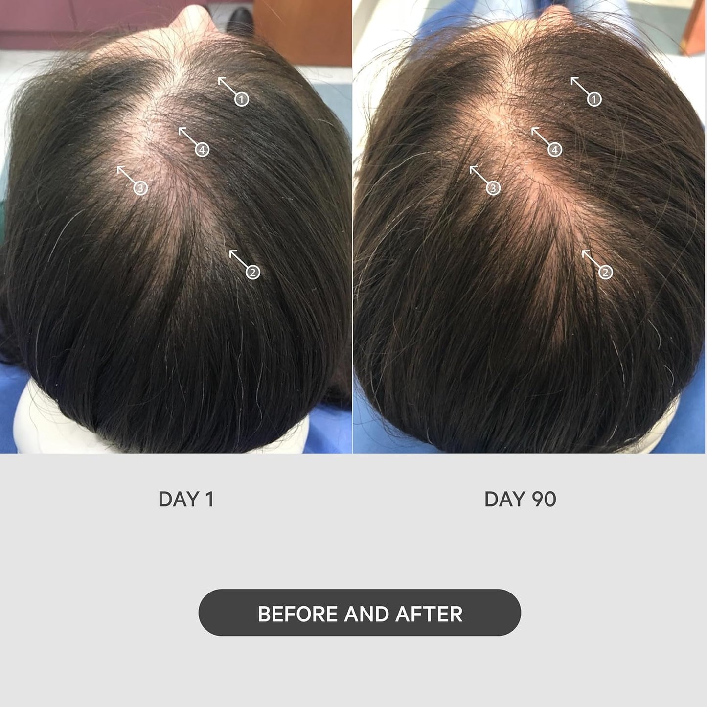 DS Labs StimuROLLER Hair Micro-Needle Hair Stimulation System 0.25mm, Packaging May Vary