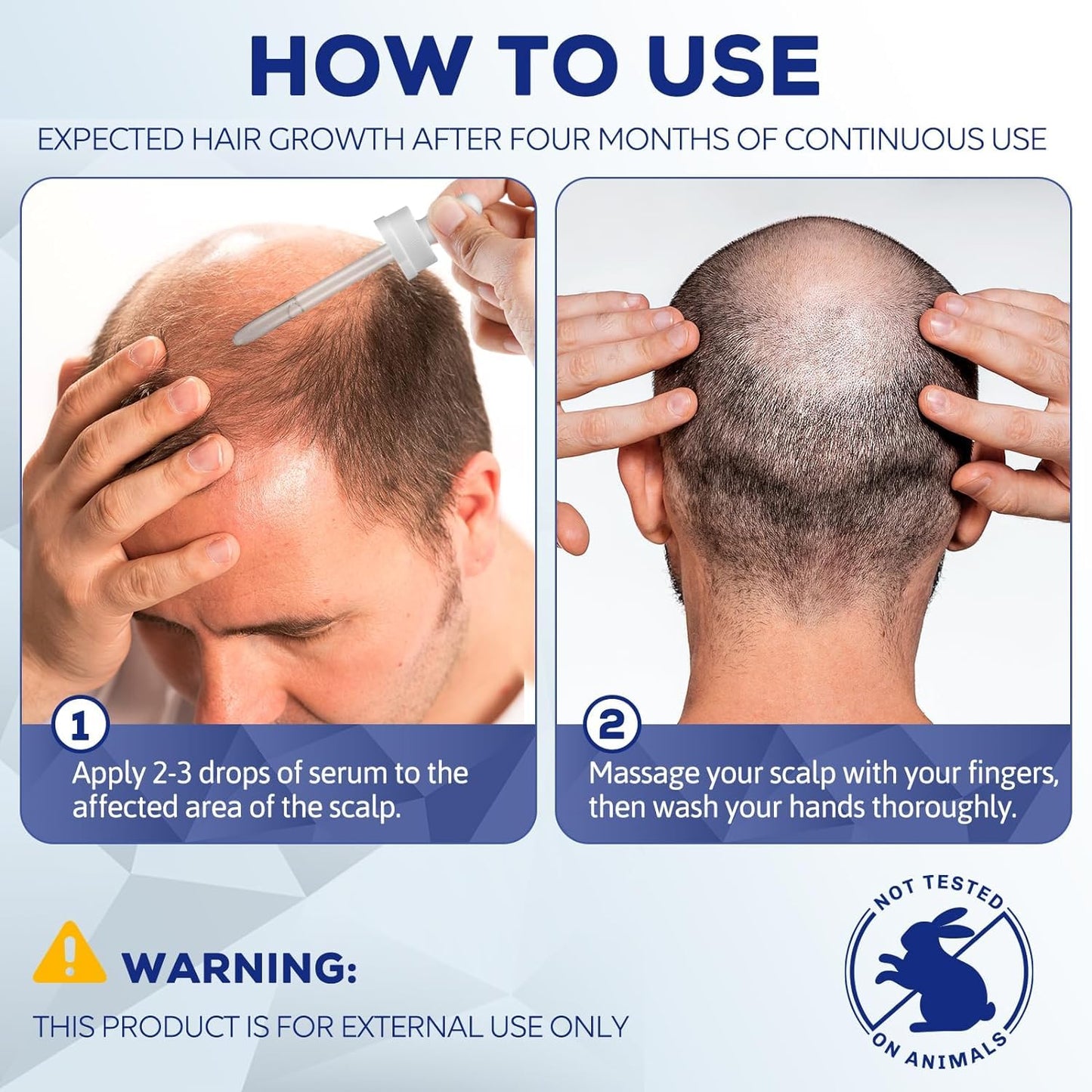 5% Minoxidil for Men and Women, Hair Regrowth Treatment for Thinning Hair and Hair Loss, Topical Solution - 3 Months Supply - Dermatologist recommended (Pack of 3)