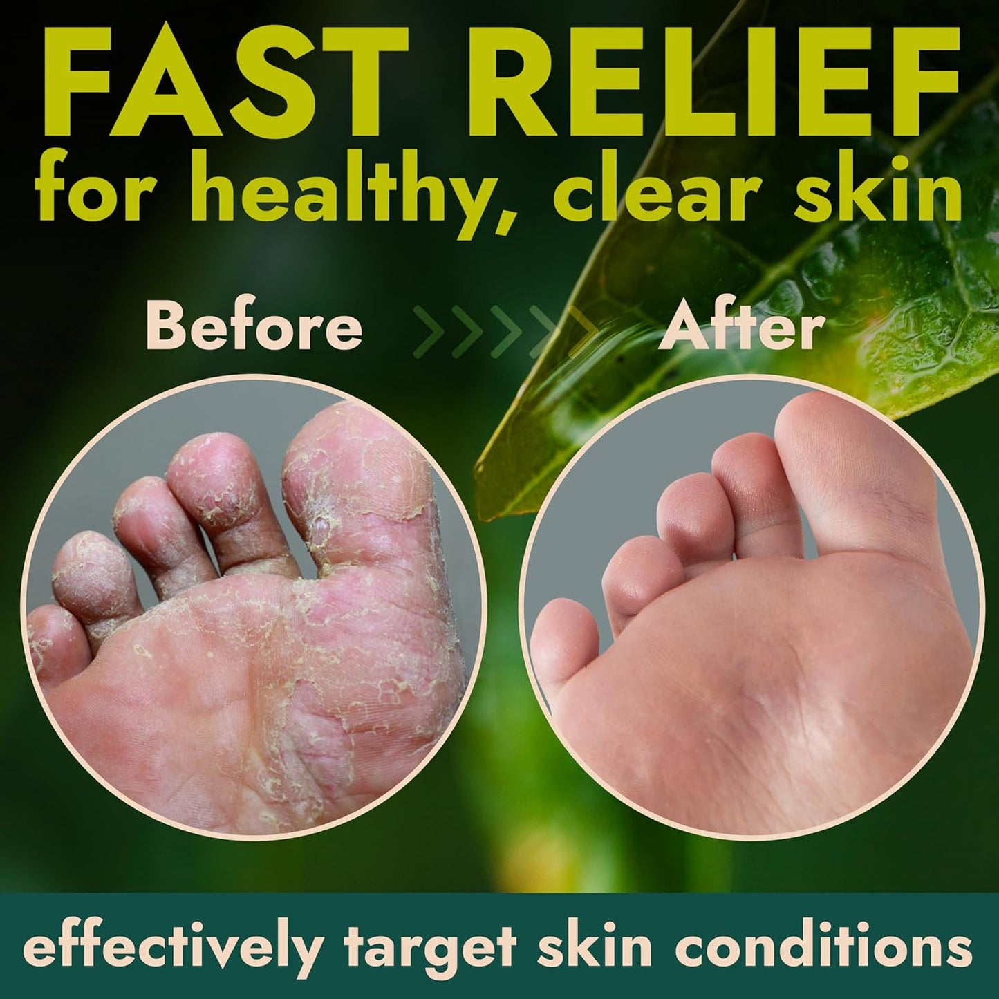 Foot Cream with Tea Tree Oil | Antifungal Cream to Soothes Cracked Heels, Dry Skin & Itchy Feet | Helps with Athlete’s Foot, Nail Fungus & Jock Itch | Relieves Itching & Burning | 4.05 fl oz