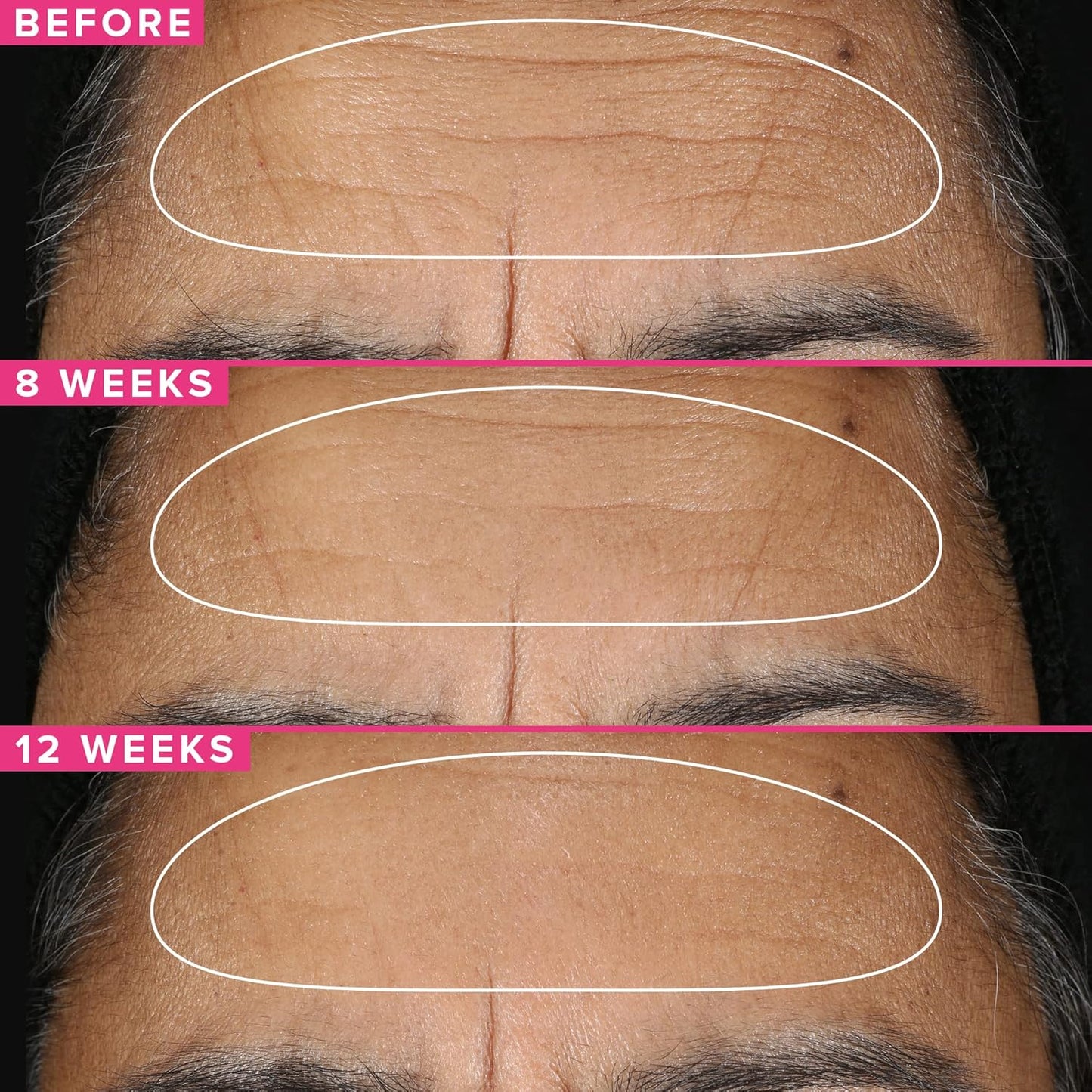 Farmacy Retinol Serum for Face - 1% Vitamin A Anti Aging - Resurfacing Wrinkle Formulated with Encapsulated Retinol + Ceramide NP to Prevent Moisture Loss + Replenish Skin Barrier (30ml)